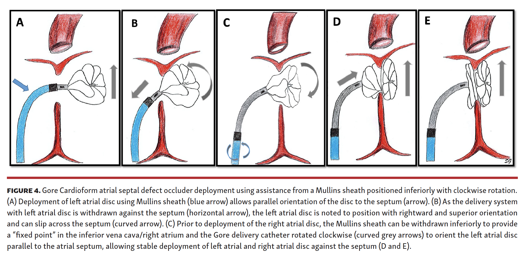 MullinsSheath Facilitated Delivery of Gore Cardioform ASD Occluder